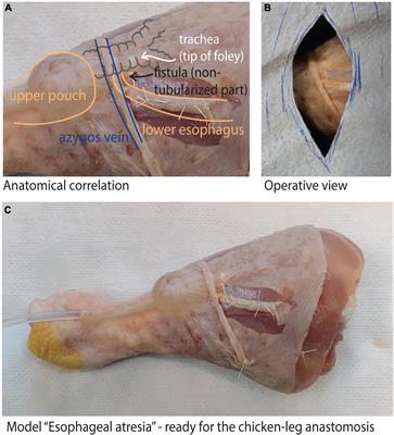 The “chicken-leg anastomosis”: Low-cost tissue-realistic simulation model for esophageal atresia training in pediatric surgery